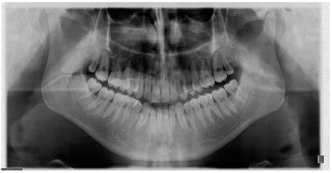 Imagine radiografie dentară panoramica pentru evaluarea chisturilor