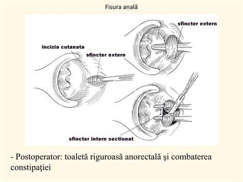Diagramă cu fluxul de prevenție a fisurii anale