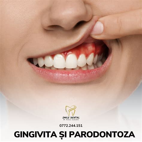Ilustrație a unei gingii sănătoase vs. gingivită