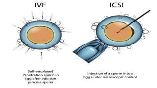 Infografic despre diferențe între FIV, ICSI, GIFT și ZIFT
