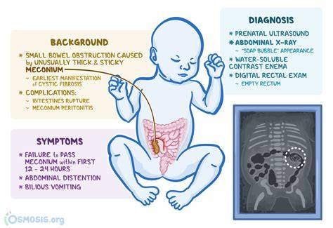 Infografic - Circulația sangvină neonatală, icter, ileus meconial