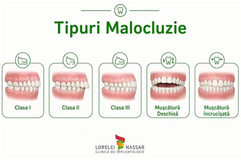 Infografic: Tipuri și greutăți fleece (g/mp) - distribuție de la microfleece la supradens
