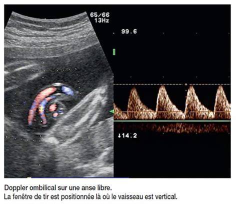 Diagrama flux Doppler: uterine, placentare, ombilicale