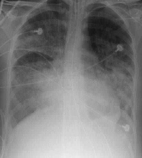 radiografie pulmonară cu detresă respiratorie la nou-născut