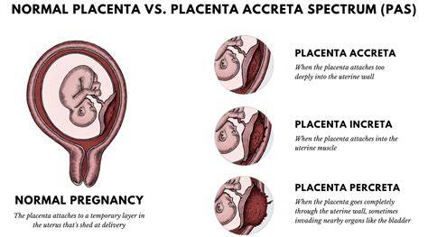 Infografic: diferentele dintre placenta praevia, accreta si abruptio