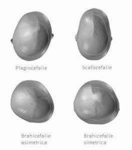 Infografic: Tipuri de plagiocefalie si cauze