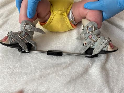 Copil cu picior strâmb congenital