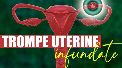 Ilustrație a trompelor uterine blocate