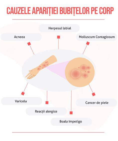 Infografic: Tipuri comune de bubițe pe corp și semnele asociate