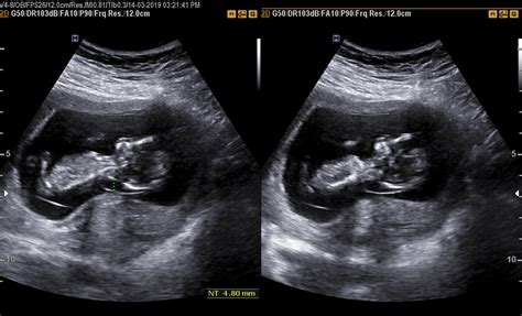 Ecografie trimestrul 1 - translucenta nucala