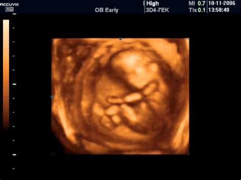 Ecografie morfologica trimestrul 2