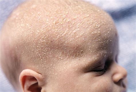 Cruste de lapte pe scalp: exemple vizuale