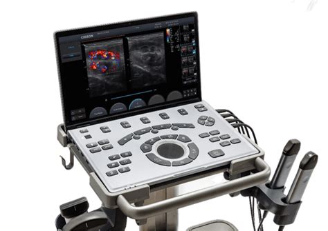 Ecran ecograf cu măsurarea translucenței nucale