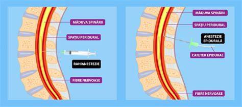 Schema alegerii tipurilor de anestezie în cezariană: epidurală, rahianestezie, generală