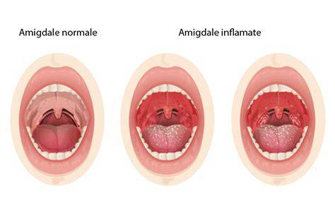 Infografic: Regim de tratament amigdalita la copii (viral vs. bacterial) - etape, durata tratamentului, rolul antibioticelor și al probioticelor