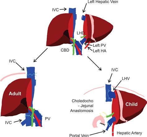 Diagramă a fluxului de transplant hepatic pediatric