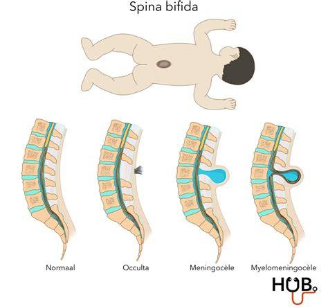 Infographic: Blocuri ale semnelor ultrasonografice în spina bifida aperta (CM obliteration, ventriculomegalie, NT, BPD)