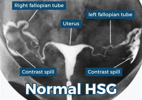 Diagramă HSG: canal cervical, cavitate uterină și trompe în timpul studiului