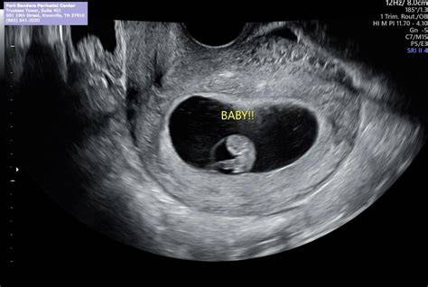 Infografic: etape ecografie early pregnancy si valori β-HCG
