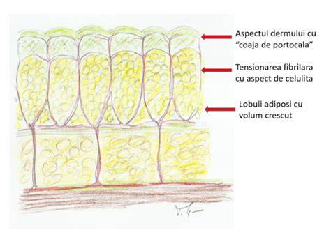 Infografic: Diferenta dintre tesut adipos subcutanat si viscerala