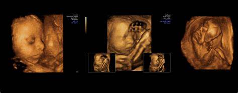 Ecografie de sarcină trimestru 3: morfologia fetală