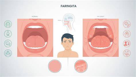 Schema comparativă: laringită acută vs. cronică