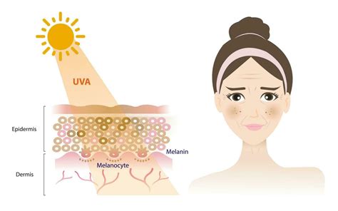 Harta iluminată a factorilor principali care contribuie la melasma: UV, hormoni, genetică