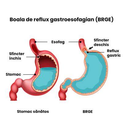 Diagramă despre funcționarea sfincterului esofagian inferior și mecanismele de barieră anti-reflux