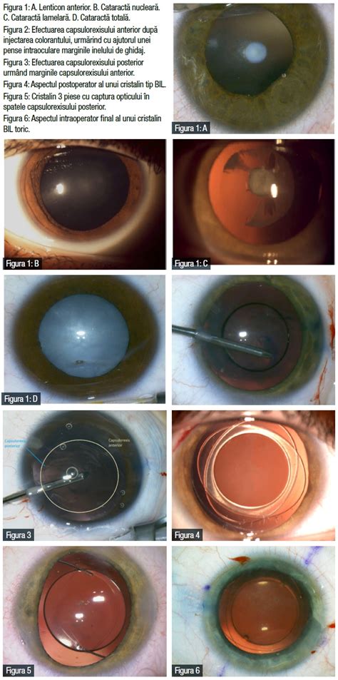 Ilustrație a cataractei congenitale