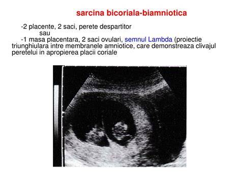 Infografic: Structuri placentare la sarcinile gemelare (monocoriotate vs bicoriotate) și riscuri asociate