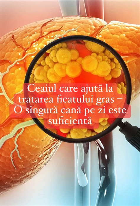 Ilustrație a ficatului afectat de steatoză