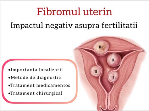 Infografic cu simptomele comune ale fibromului uterin.