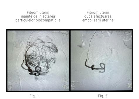 Schema procedurii de embolizare a arterelor uterine.