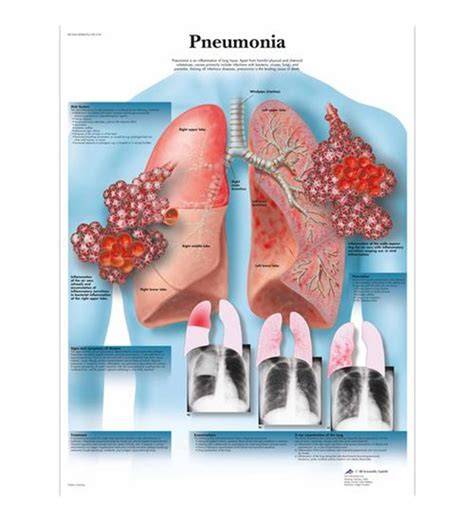 Diagrama: evoluția pneumoniei stafilococice de la infecție virală la complicații