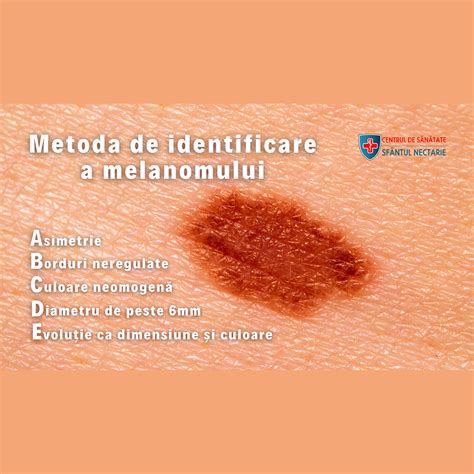 Infografic: Semnele ABCDE ale alunițelor