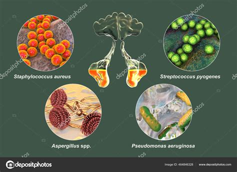 Infografic: Calea toxinelor Streptococcus pyogenes și Staphylococcus aureus către producerea de toxine și răspunsul imun
