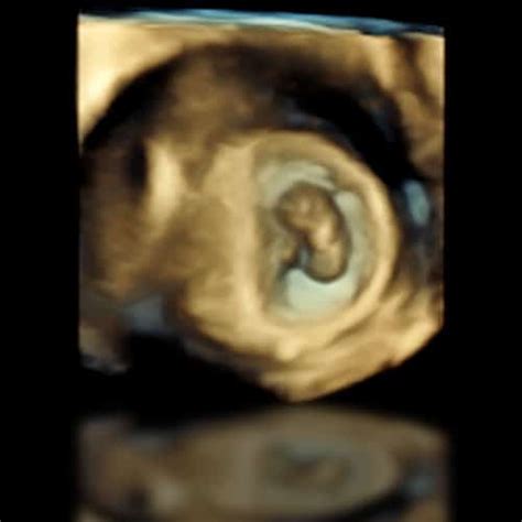 ecografie 3D cu un făt