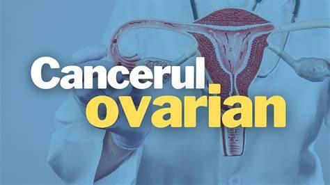 Infografic: etape diagnostice si tratament in cancerul ovarian