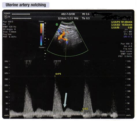 doppler_artere_uterine.png