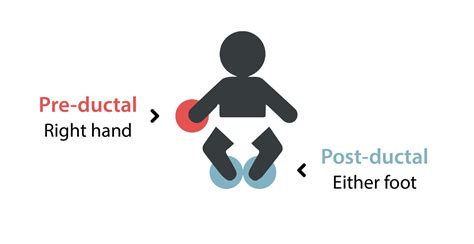Infografic despre algoritmul screeningului neonatal cu pulsoximetrie: preductal vs postductal
