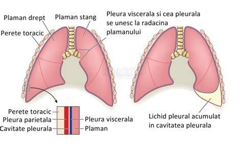 Structura plamanilor si spatiul pleural; pneumotorax neonatal