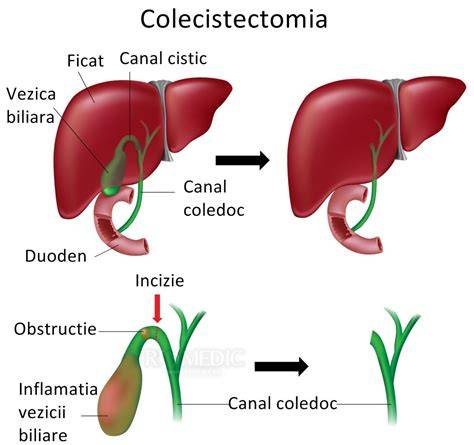Schema comparativa: interventie deschisa vs. laparoscopica
