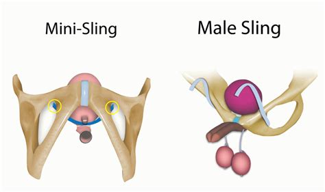 Diagrama sling uretral mijlociu