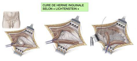Schema chirurgiei cu plasă pentru hernie inghinala (Lichtenstein)