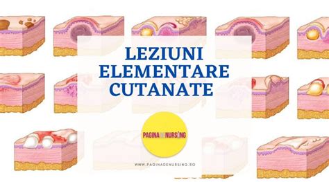 Ilustrație a diferitelor tipuri de leziuni cutanate cauzate de stafilococ auriu
