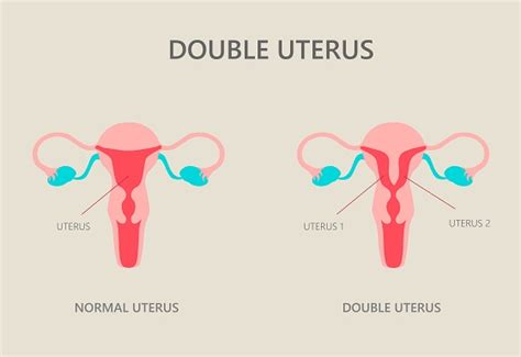 Infografic: Tipuri de malformații uterine congenitale (uter didelf, unicorn, bicorn, etc.)