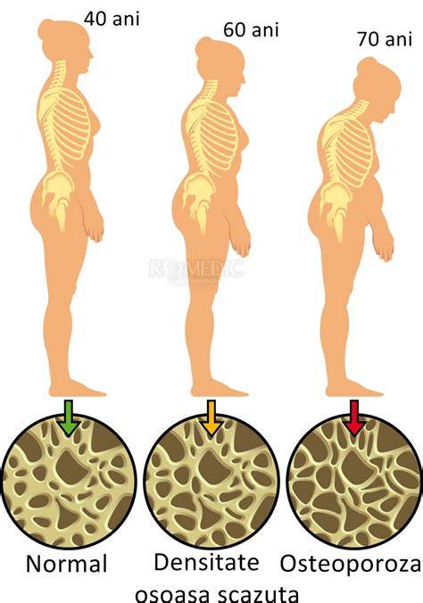 Infografie: factori de risc și screening osteoporoză