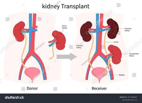 Schema fluxului de transplant renal pediatric
