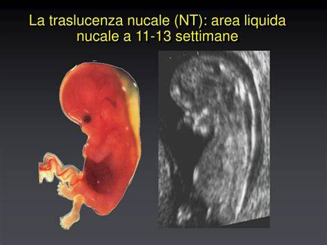 Ilustrație: măsurarea translucenței nucale (NT) la 11-14 săptămâni