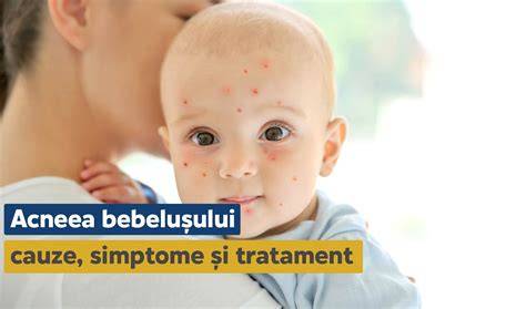 Imagine infografic: cauze ale acneei bebelușului, milia și îngrijire corectă a pielii